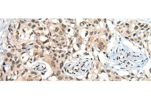 Immunohistochemistry of paraffin-embedded Human lung cancer tissue using CDKL2 Polyclonal Antibody at dilution of 1:25(x200) (CDKL2 anticorps)