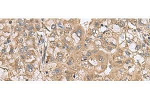 Immunohistochemistry of paraffin-embedded Human liver cancer tissue using PAPSS2 Polyclonal Antibody at dilution of 1:60(x200)