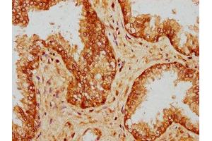 IHC image of ABIN7169288 diluted at 1:200 and staining in paraffin-embedded human prostate cancer performed on a Leica BondTM system.
