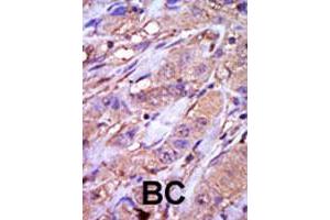 Formalin-fixed and paraffin-embedded human cancer tissue reacted with CSNK1E polyclonal antibody  , which was peroxidase-conjugated to the secondary antibody, followed by DAB staining. (CK1 epsilon anticorps  (C-Term))