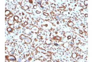 Formalin-fixed, paraffin-embedded human Renal Cell Carcinoma stained with Emerin Mouse Monoclonal Antibody (EMD/2167). (Emerin anticorps  (AA 56-167))