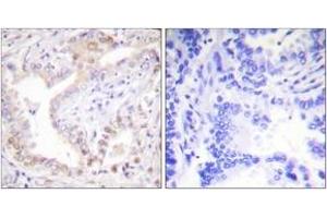 Immunohistochemistry analysis of paraffin-embedded human lung carcinoma tissue, using Lamin A (Cleaved-Asp230) Antibody.