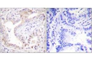 Immunohistochemistry analysis of paraffin-embedded human lung carcinoma tissue, using Lamin A (Cleaved-Asp230) Antibody. (Lamin A/C anticorps  (Cleaved-Asp230))