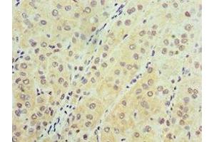 Immunohistochemistry of paraffin-embedded human liver cancer using ABIN7143632 at dilution of 1:100