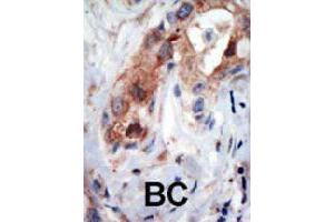 Formalin-fixed and paraffin-embedded human cancer tissue reacted with PIP5K1B polyclonal antibody  , which was peroxidase-conjugated to the secondary antibody, followed by AEC staining. (PIP5K1B anticorps  (N-Term))