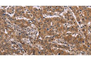 Immunohistochemistry of paraffin-embedded Human liver cancer tissue using FAAH2 Polyclonal Antibody at dilution 1:30 (FAAH2 anticorps)