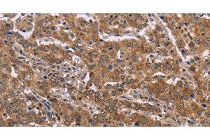 Immunohistochemistry of paraffin-embedded Human liver cancer tissue using FAAH2 Polyclonal Antibody at dilution 1:30
