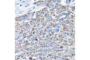 Immunohistochemistry of paraffin-embedded human esophageal cancer using ETFA Rabbit pAb  at dilution of 1:200 (40x lens). (ETFA anticorps  (AA 1-333))