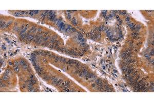 Immunohistochemistry of paraffin-embedded Human colon cancer tissue using CDC5L Polyclonal Antibody at dilution 1:40 (CDC5L anticorps)