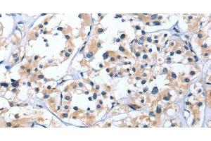 Immunohistochemistry of paraffin-embedded Human thyroid cancer tissue using EDN3 Polyclonal Antibody at dilution 1:30 (Endothelin 3 anticorps)