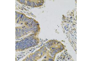 Immunohistochemistry of paraffin-embedded human colon carcinoma using MYD88 Antibody (ABIN6290608) at dilution of 1:100 (40x lens).