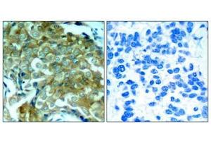 Immunohistochemical analysis of paraffin-embedded human breast carcinoma tissue using EGFR(Phospho-Tyr1172) Antibody(left) or the same antibody preincubated with blocking peptide(right). (EGFR anticorps  (pTyr1172))