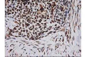 Immunohistochemical staining of paraffin-embedded Adenocarcinoma of Human breast tissue using anti-ERCC4 mouse monoclonal antibody. (ERCC4 anticorps)