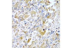 Immunohistochemistry of paraffin-embedded human lung cancer using HAVCR2 antibody at dilution of 1:100 (x40 lens). (TIM3 anticorps)
