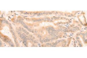 Immunohistochemistry of paraffin-embedded Human thyroid cancer tissue using ELP4 Polyclonal Antibody at dilution of 1:25(x200) (ELP4 anticorps)