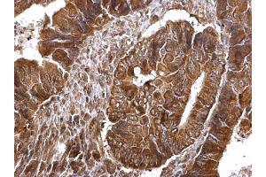 IHC-P Image Thymidylate synthetase antibody detects Thymidylate synthetase protein at cytosol and nucleus on human colon carcinoma by immunohistochemical analysis.