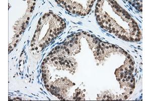 Immunohistochemical staining of paraffin-embedded Adenocarcinoma of Human ovary tissue using anti-ERCC1 mouse monoclonal antibody. (ERCC1 anticorps)