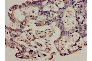 Immunohistochemistry analysis of human pancreatic cancer using ABIN7171289 at dilution of 1:100 (TCRb anticorps  (AA 22-115))