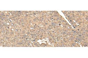 Immunohistochemistry of paraffin-embedded Human liver cancer tissue using BDH2 Polyclonal Antibody at dilution of 1:65(x200) (BDH2 anticorps)
