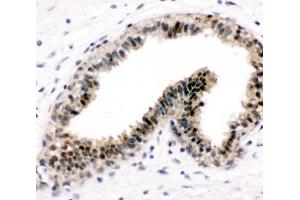 IHC-P: VCP antibody testing of human breast cancer tissue (VCP anticorps  (C-Term))