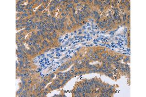 Immunohistochemistry of Human cervical cancer using NBEA Polyclonal Antibody at dilution of 1:60 (Neurobeachin anticorps)