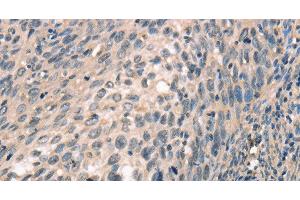 Immunohistochemistry of paraffin-embedded Human cervical cancer tissue using CDK12 Polyclonal Antibody at dilution 1:30 (CDK12 anticorps)