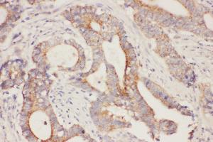 Anti- Fatty Acid Binding Protein 5 antibody, IHC(P) IHC(P): Human Intestinal Cancer Tissue (FABP5 anticorps  (N-Term))