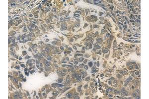 ABIN7096246 and ABIN7100308 at 1/100 staining human lung squamous cell carcinoma by IHC-P.