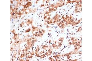 Immunohistochemistry of paraffin-embedded Human liver cancer using Phospho-STAT1(S727) Polyclonal Antibody at dilution of 1:100 (40x lens). (STAT1 anticorps  (pSer727))