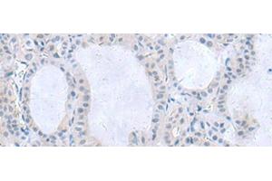 Immunohistochemistry of paraffin-embedded Human thyroid cancer tissue using IL1B Polyclonal Antibody at dilution of 1:55(x200) (IL-1 beta anticorps)