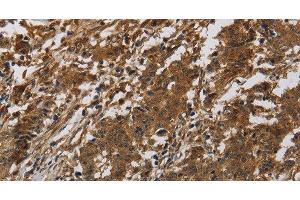Immunohistochemistry of paraffin-embedded Human liver cancer tissue using ITGB7 Polyclonal Antibody at dilution of 1:40 (Integrin beta 7 anticorps)