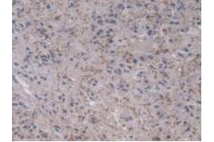Detection of UBE2L3 in Human Glioma Tissue using Polyclonal Antibody to Ubiquitin Conjugating Enzyme E2L3 (UBE2L3)