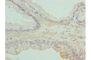 Immunohistochemistry of paraffin-embedded human prostate cancer using ABIN7143144 at dilution of 1:100