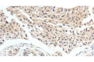 Immunohistochemistry of paraffin-embedded Human lung cancer tissue using MDK Polyclonal Antibody at dilution 1:60 (Midkine anticorps)