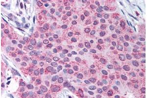 Human Breast Carcinoma (formalin-fixed, paraffin-embedded) stained with MMP13 antibody ABIN290538 at 50 ug/ml followed by biotinylated goat anti-rabbit IgG secondary antibody ABIN481713, alkaline phosphatase-streptavidin and chromogen. (MMP13 anticorps  (C-Term))