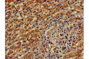 Immunohistochemistry of paraffin-embedded human liver cancer using ABIN7148816 at dilution of 1:100 (CREB3L1 anticorps  (AA 396-500))