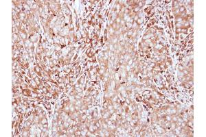 IHC-P Image Immunohistochemical analysis of paraffin-embedded A549 xenograft, using MMP3, antibody at 1:500 dilution. (MMP3 anticorps)