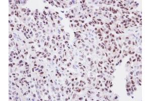 IHC-P Image Immunohistochemical analysis of paraffin-embedded CL1-0 Xenograft, using ORC2, antibody at 1:100 dilution.