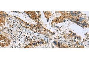 Immunohistochemistry of paraffin-embedded Human cervical cancer tissue using TUBD1 Polyclonal Antibody at dilution of 1:70(x200) (TUBD1 anticorps)