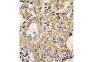 Formalin-fixed and paraffin-embedded human breast carcinoma tissue reacted with Parg antibody (C-term) (ABIN391439 and ABIN2841426) , which was peroxidase-conjugated to the secondary antibody, followed by DAB staining. (PARG anticorps  (C-Term))