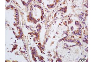 Formalin-fixed and paraffin embedded human gastric carcinoma labeled with Anti GNA12/G protein alpha 12 Polyclonal Antibody, Unconjugated (ABIN753958) at 1:200 followed by conjugation to the secondary antibody and DAB staining (GNA12 anticorps  (AA 301-381))