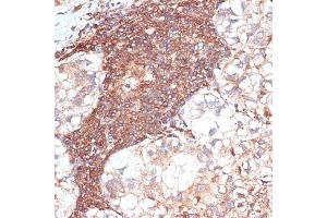 Immunohistochemistry of paraffin-embedded human liver cancer using G3BP1 antibody (ABIN7267528) at dilution of 1:100 (40x lens). (G3BP1 anticorps  (AA 131-330))