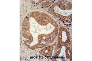 CSGALNACT1 Antibody (Center) (ABIN651115 and ABIN2840081) immunohistochemistry analysis in formalin fixed and paraffin embedded human prostate carcinoma followed by peroxidase conjugation of the secondary antibody and DAB staining.