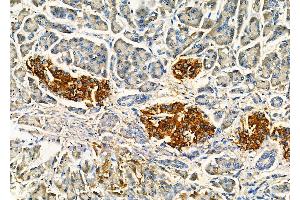 ABIN7093901 and ABIN7097945 at 1/100 staining Human gastric cancer and adjacent non-tumor tissue by IHC-P. (IMPDH1 anticorps  (C-Term))