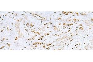 Immunohistochemistry of paraffin-embedded Human gastric cancer tissue using FOXQ1 Polyclonal Antibody at dilution of 1:25(x200) (FOXQ1 anticorps)