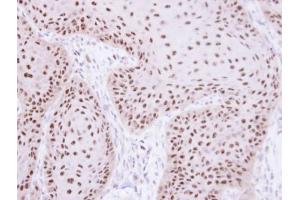 IHC-P Image Immunohistochemical analysis of paraffin-embedded Cal27 xenograft, using RPA 70 kDa subunit , antibody at 1:100 dilution.