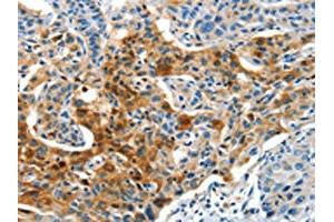 The image on the left is immunohistochemistry of paraffin-embedded Human lung cancer tissue using ABIN7190321(COG1 Antibody) at dilution 1/60, on the right is treated with synthetic peptide. (COG1 anticorps)