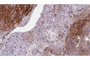 ABIN6276819 at 1/100 staining Human urothelial cancer tissue by IHC-P. (S100A8 anticorps  (C-Term))