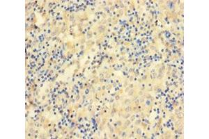 Immunohistochemistry of paraffin-embedded human lung cancer using ABIN7156529 at dilution of 1:100 (CCDC36 anticorps  (AA 11-592))