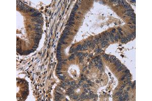 Immunohistochemistry of Human cervical cancer using FSTL1 Polyclonal Antibody at dilution of 1:30